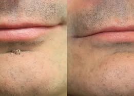🔥 Curalona®2-in-1 Microneedle & Hydrocolloid Patch🍀| Removes Raised Moles, Acne, Flat Warts & Skin Tags | Helps Improve Wrinkles, Scars & Blemishes | Invisible Patches for Face & Body