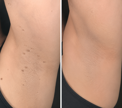 🔥 Curalona®2-in-1 Microneedle & Hydrocolloid Patch🍀| Removes Raised Moles, Acne, Flat Warts & Skin Tags | Helps Improve Wrinkles, Scars & Blemishes | Invisible Patches for Face & Body