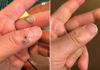 🔥 Curalona®2-in-1 Microneedle & Hydrocolloid Patch🍀| Removes Raised Moles, Acne, Flat Warts & Skin Tags | Helps Improve Wrinkles, Scars & Blemishes | Invisible Patches for Face & Body
